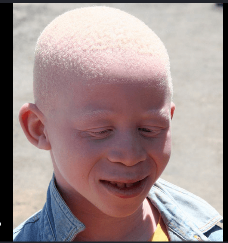 Illustration du casting Black Model with Albinism — Merch Photo &amp; Video Shoot
